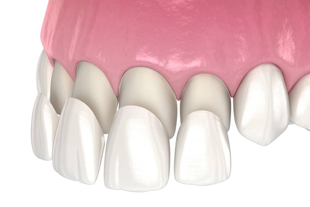 Are Dental Veneers