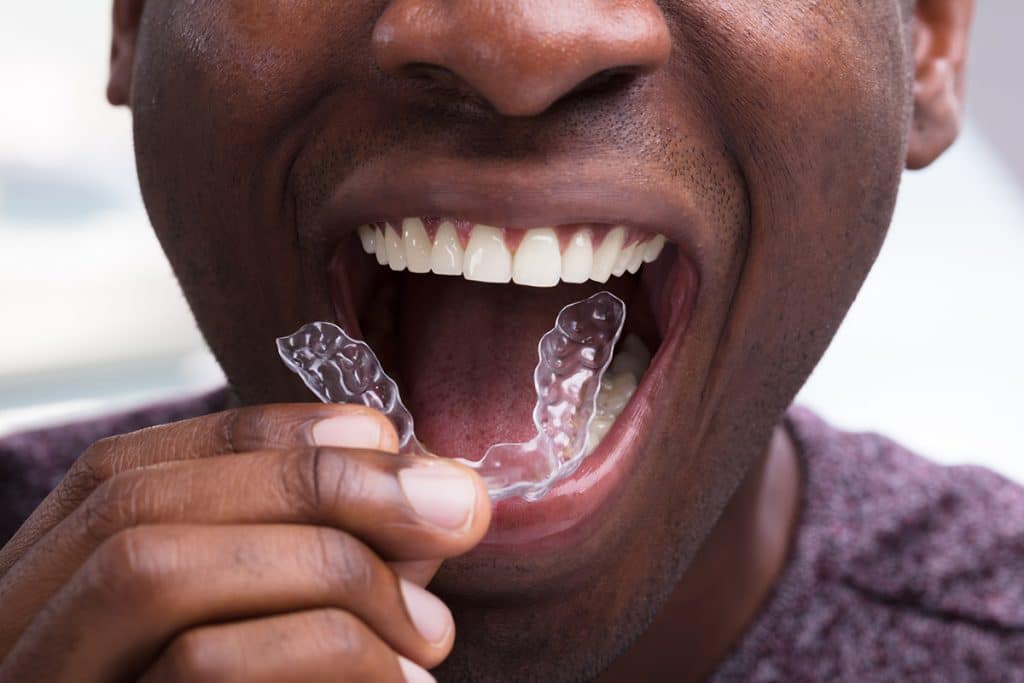 Do You Need to See an Orthodontist for Invisalign?