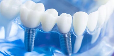 Dental Implants Image